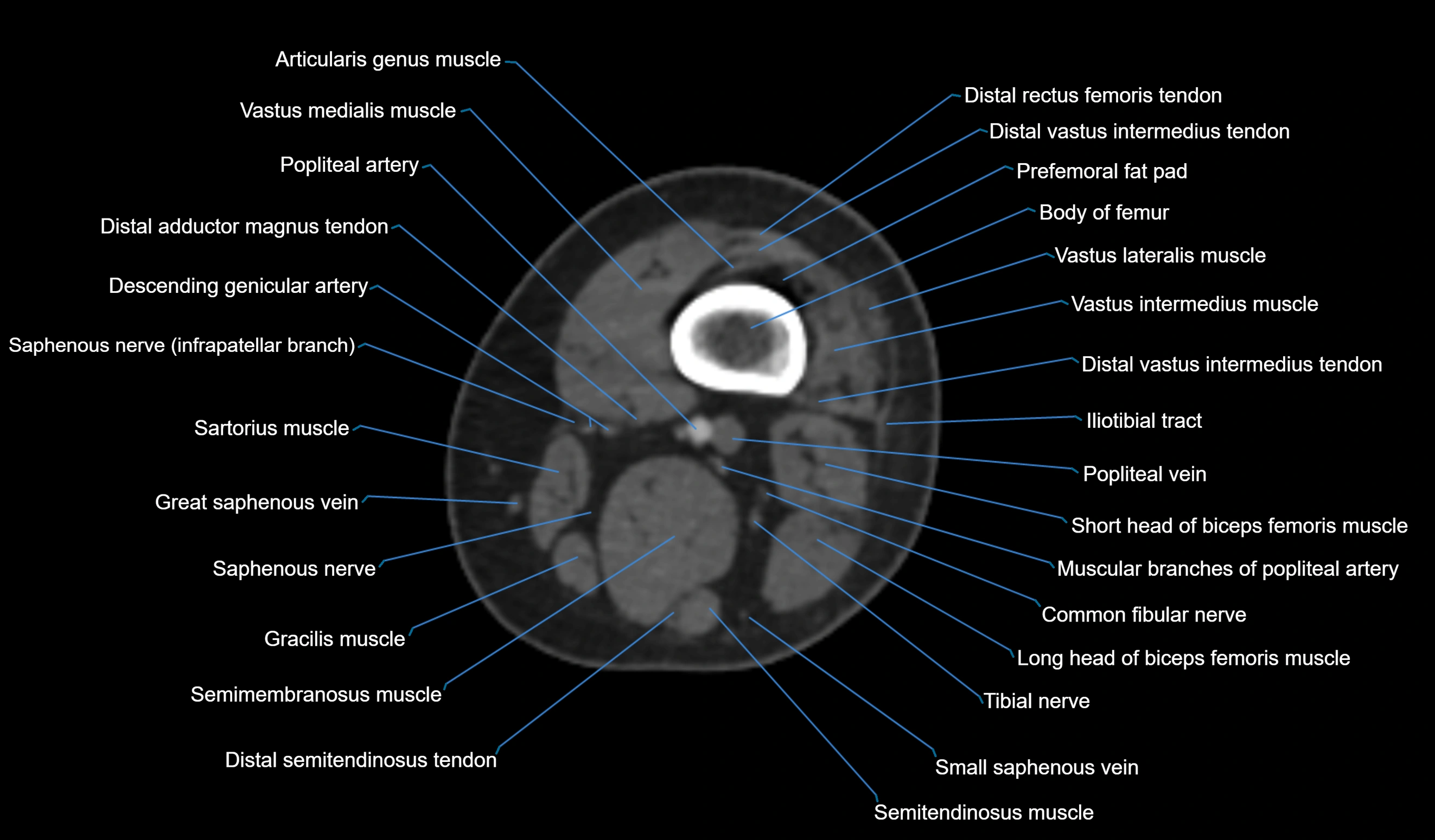 CT knee axial cross sectional anatomy labelled image-00005.webp